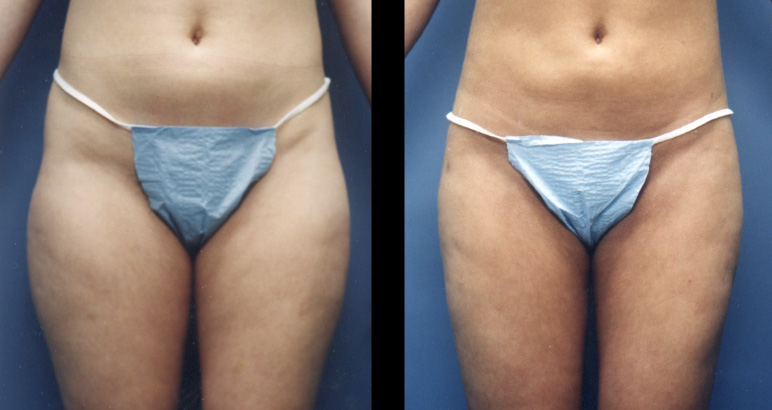 liposuction1F-L