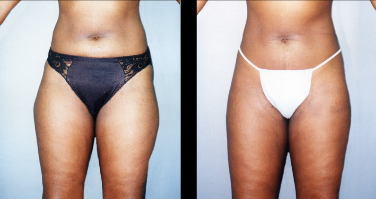 liposuction2F-L