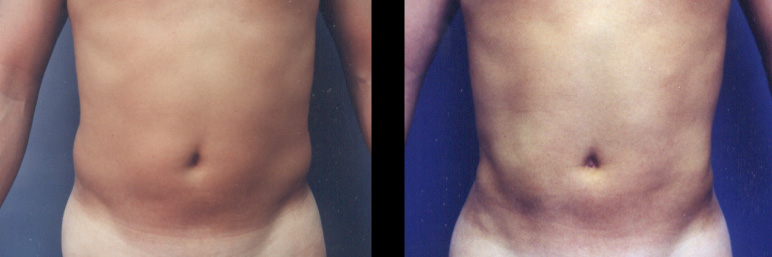 liposuction3F-L