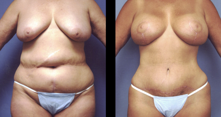 abdominoplasty10005F-L