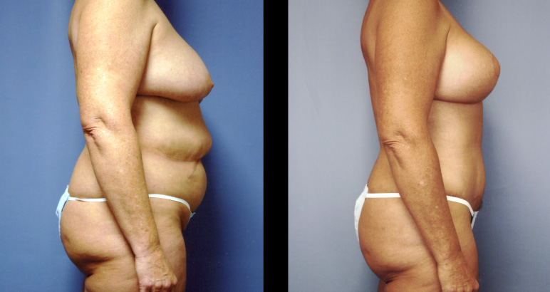 abdominoplasty10005P-L