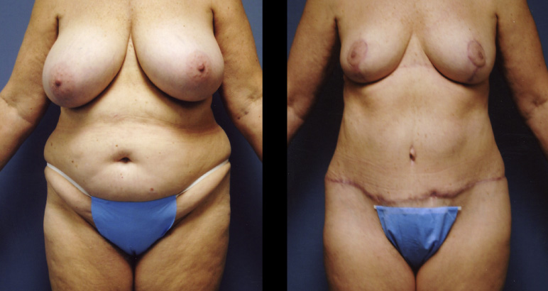 abdominoplasty11092F-L