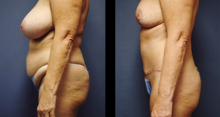 abdominoplasty11092L-L