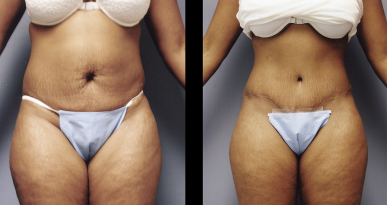 abdominoplasty11336F-L