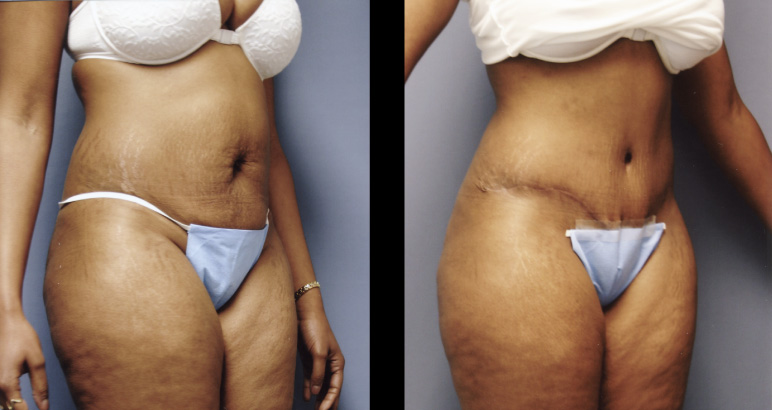 abdominoplasty11336R-L