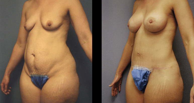 abdominoplasty12544L-L