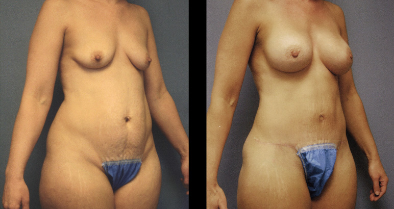 abdominoplasty12544R-L