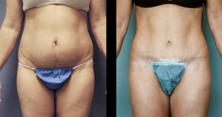 abdominoplasty12628F-L