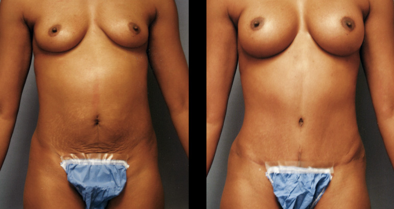 abdominoplasty12889F-L