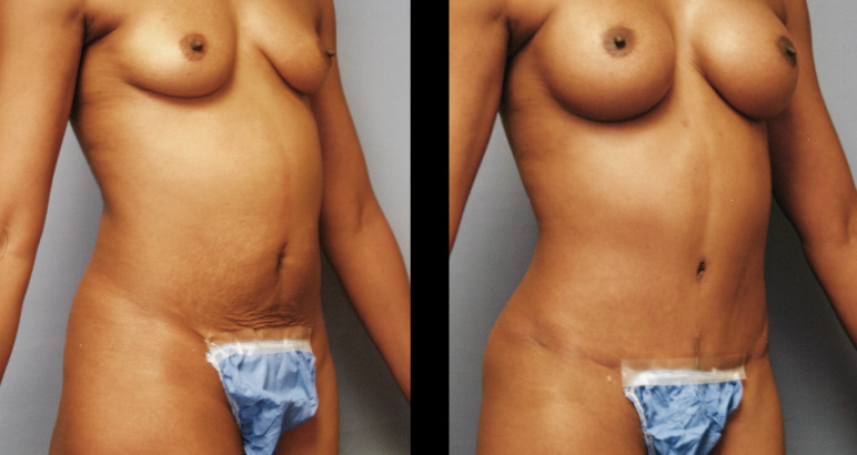 abdominoplasty12889P-L