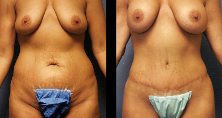 abdominoplasty13164F-L