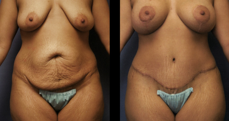 abdominoplasty3193F-L