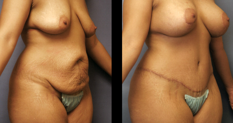 abdominoplasty3193P-L