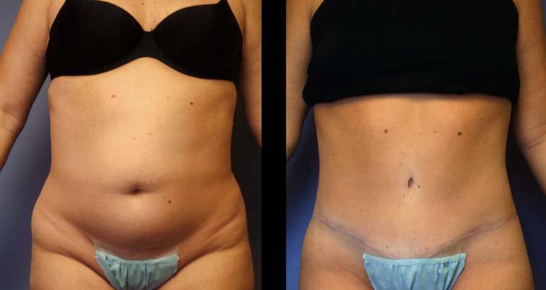 abdominoplasty7254F-L