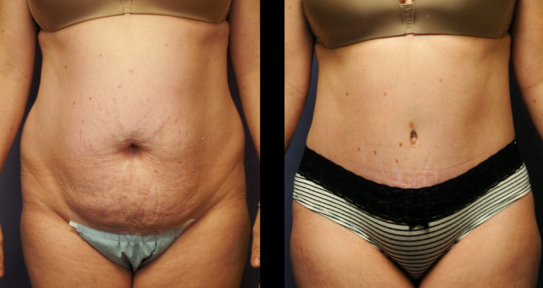 abdominoplasty7563F-L