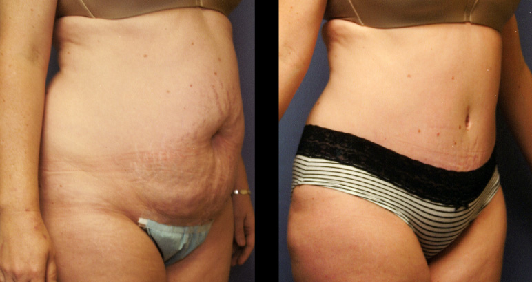 abdominoplasty7563P-L