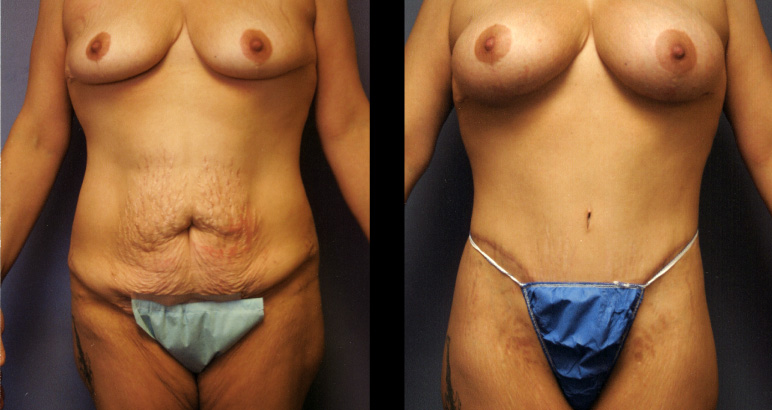 abdominoplasty7735F-L