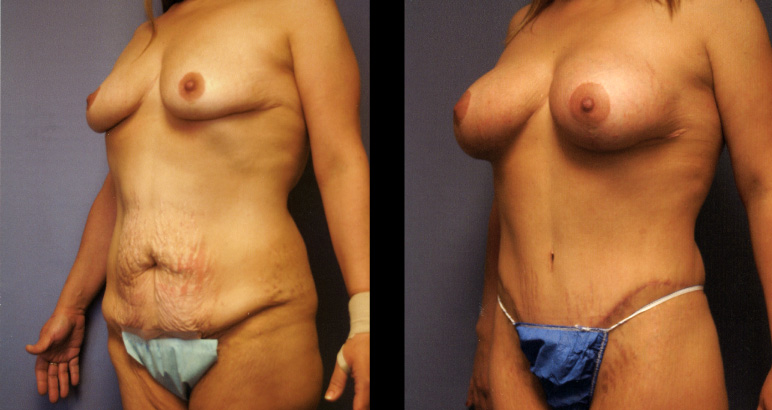 abdominoplasty7735P-L