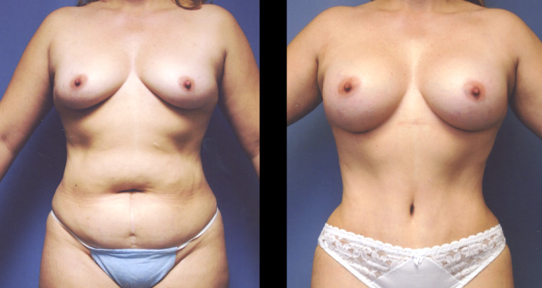 abdominoplasty8566F-L