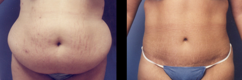 abdominoplastyLL-L