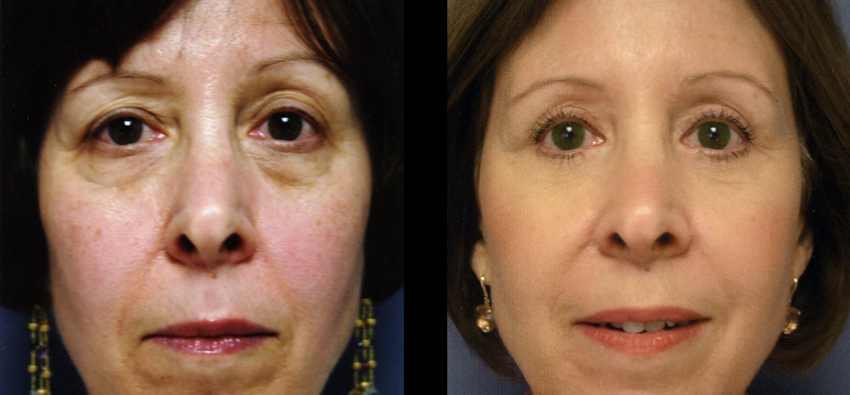 blepharoplasty11258F-L