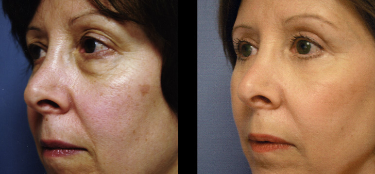 blepharoplasty11258L-L