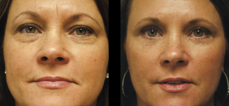 non invasive tummy tuck near me non invasive tummy tuck near me
