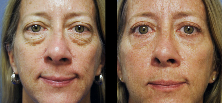 blepharoplasty12972F-L