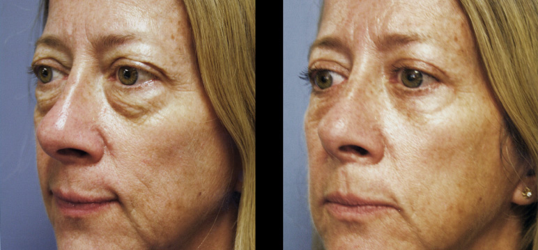 blepharoplasty12972S-L