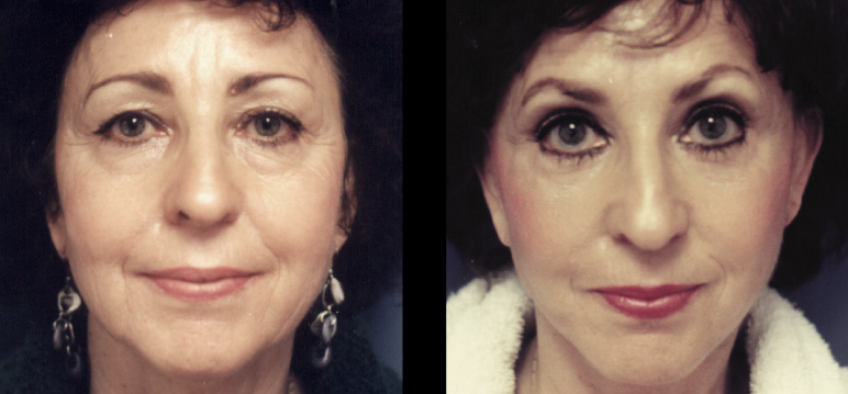 blepharoplasty4041-L